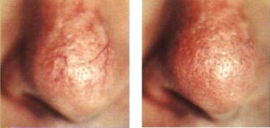 tratar rosacea